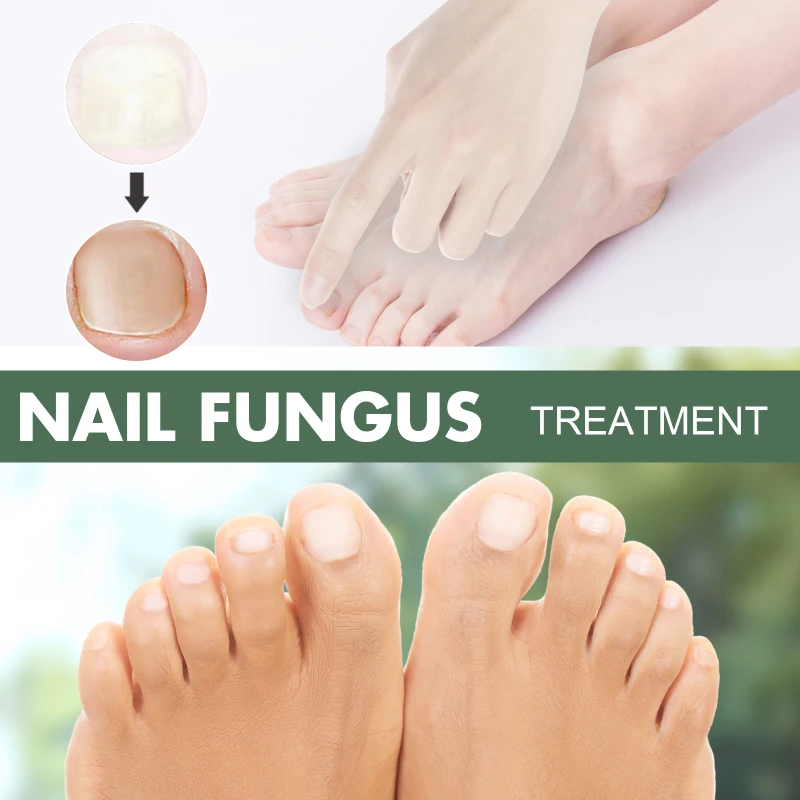 ciuperca foarte avansată a unghiilor de la picioare tratamentul ciupercii unghiilor cu săpun și sifon